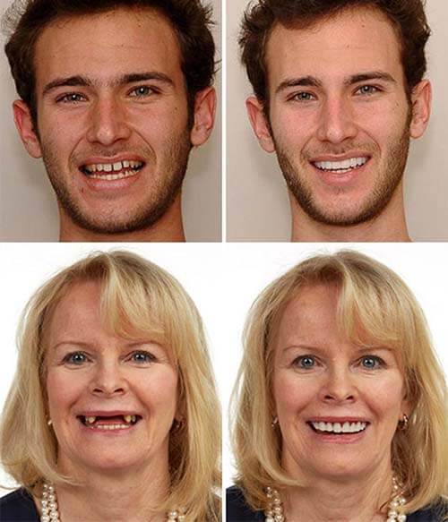 Универсальные виниры Perfect Smile Veneers
Универсальные виниры Perfect Smile Veneers