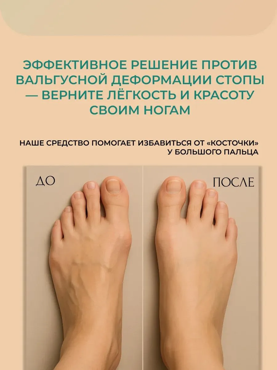 Вальгомед (Valgomed) — натуральный гель для коррекции и облегчения симптомов вальгусной деформации стопы Вальгомед (Valgomed) — натуральный гель для коррекции и облегчения симптомов вальгусной деформации стопы