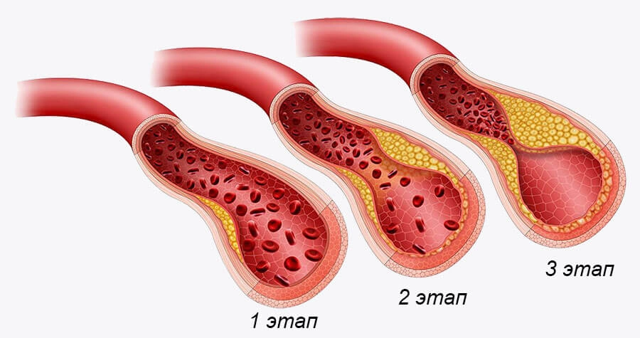 Артери Гель (Artery Gel) — гель для сердца и сосудов: купить в России Артери Гель (Artery Gel) — гель для сердца и сосудов: купить в России