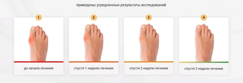 Вальгомед (Valgomed) — натуральный гель для коррекции и облегчения симптомов вальгусной деформации стопы Вальгомед (Valgomed) — натуральный гель для коррекции и облегчения симптомов вальгусной деформации стопы